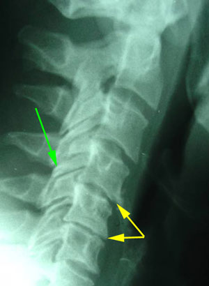 disc degeneration treated at Johnson Chiropractic