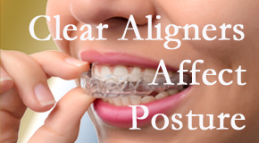 Clear aligners influence posture which Richmond chiropractic helps.