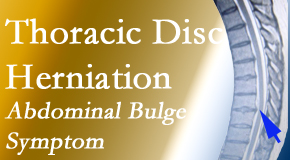 Johnson Chiropractic treats thoracic disc herniation that for some patients prompts abdominal pain.