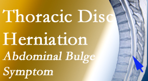 Johnson Chiropractic cares for thoracic disc herniation that for some patients prompts abdominal pain.