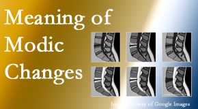 Johnson Chiropractic sees many back pain and neck pain patients who bring their MRIs with them to the office. Modic changes are often noted. 