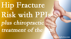 Johnson Chiropractic shares new research describing increased risk of hip fracture with proton pump inhibitor use. 