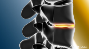 Richmond degenerative spinal changes 