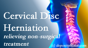 Johnson Chiropractic uses the Cox® Technic spinal manipulation to treat cervical radiculopathy and avert surgery.