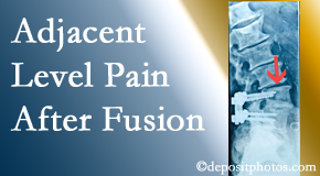Johnson Chiropractic offers relieving care non-surgically to back pain patients suffering with adjacent level pain after spinal fusion surgery.
