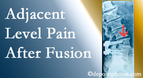 Johnson Chiropractic offers relieving care non-surgically to back pain patients experiencing adjacent level pain after spinal fusion surgery.