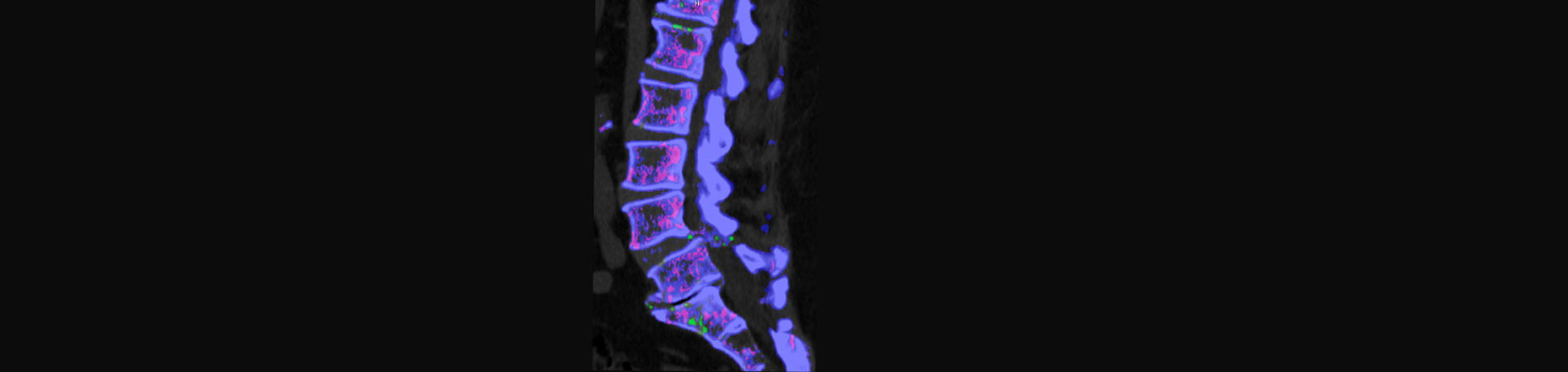 Johnson Chiropractic is aware that inflammatory spinal gout is a differential diagnosis to consider for patients who present with back pain and other spine related symptoms.