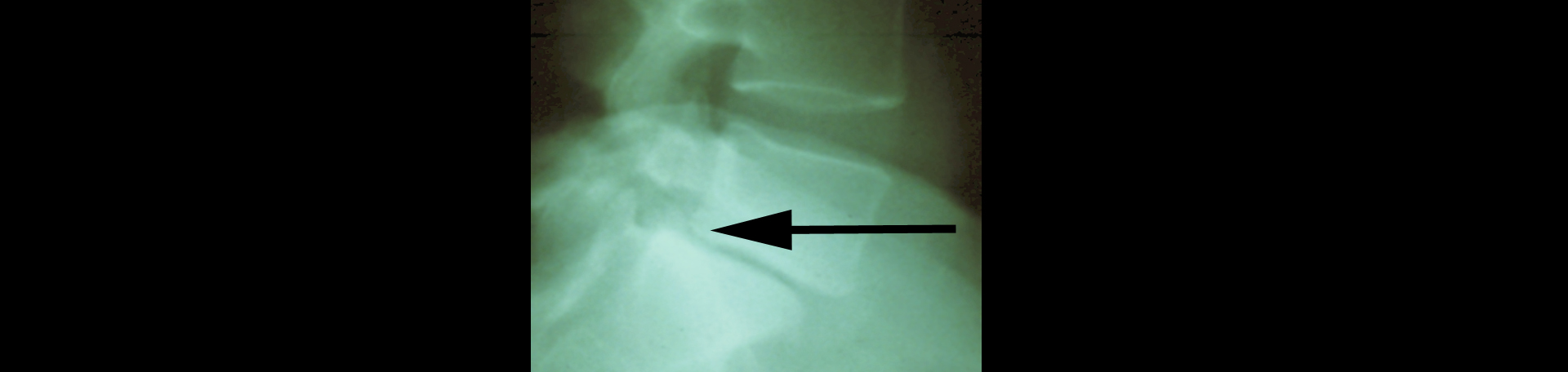 Richmond spondylolisthesis