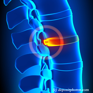 picture of lumbar Richmond disc herniation