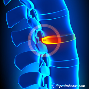 image of lumbar Richmond disc herniation