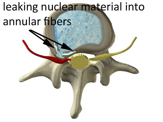 leaking nuclear disc material into the surrounding fibers of the disc