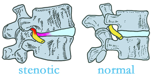 Richmond stenotic and normal spinal discs