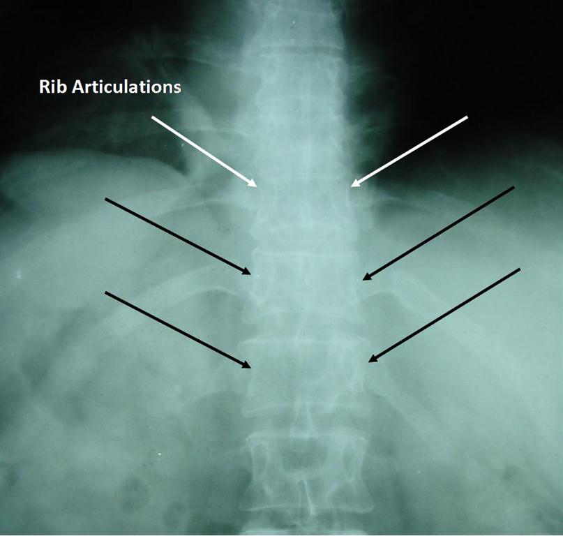 Normal Thoracic Spine | Johnson Chiropractic